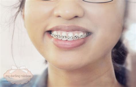 false braces for teeth costume.